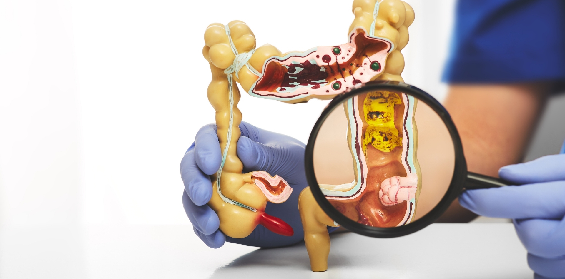 Trattamento diverticolite a Roma